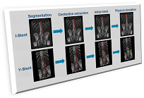 Stent Simulation Workflow